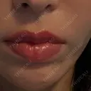 ボトックス（あご） / ボトックス（口角） / ボトックス（人中） 春山記念病院 BEFORE サムネイル用