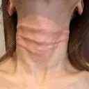 スネコス ミニマムスキンクリニック銀座 BEFORE サムネイル用