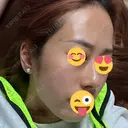 その他（肌） / ポテンツァ ゆう美容クリニック BEFORE サムネイル用