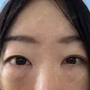 クマ治療 / ボトックス（あご） / 肌ヒアルロン酸注入（たるみ・シワ改善） / ヒアルロン酸注入（目の下） / ボトックス（眉間） / ボトックス（目尻） / ボトックス（額） / その他（鼻） TCB東京中央美容外科 名古屋栄院 BEFORE サムネイル用