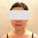 糸リフト / 脂肪吸引（顔） / 脂肪吸引（二の腕） / 脂肪注入（額） 脂肪吸引ラボトウキョウ BEFORE サムネイル用