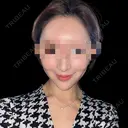 ハイフ（顔） DAILY SKIN CLINIC 福岡院 BEFORE サムネイル用