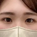 クマ治療 TCB東京中央美容外科 前橋院 BEFORE サムネイル用