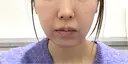 脂肪吸引（顔） ルラ美容クリニック 名古屋栄院 / ルラスキンクリニック 名古屋栄院 BEFORE サムネイル用