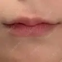 ヒアルロン酸注入（唇） AZ BEAUTY CLINIC BEFORE サムネイル用
