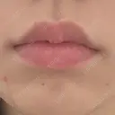 ボトックス（口角） / ボトックス（肩） DMTC CLINIC 日本橋院 BEFORE サムネイル用