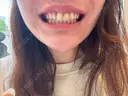 ホワイトニング ビジューデンタルサロン BEFORE サムネイル用