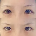 二重切開 アネシス美容クリニック BEFORE サムネイル用