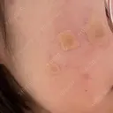 ほくろ・いぼ除去レーザー（肌） Fellez Clinic【フェルズクリニック】 BEFORE サムネイル用