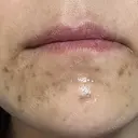 医療脱毛（ワキ） / ルメッカ ルラ美容クリニック 広島院 BEFORE サムネイル用