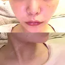 RF（高周波）たるみ治療 オラクル美容皮膚科 東京新宿院 BEFORE サムネイル用