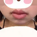 ボトックス（エラ・小顔） / ボトックス（口角） TCB東京中央美容外科 つくば院 BEFORE サムネイル用