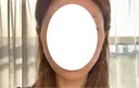 糸リフト Stand by Beauty Clinic BEFORE サムネイル用