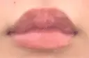 ヒアルロン酸注入（涙袋） / ヒアルロン酸注入（唇） / ボトックス（口角） ルラ美容クリニック 名古屋本院 BEFORE サムネイル用