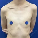 豊胸（脂肪注入） 湘南美容クリニック 吉祥寺院 BEFORE サムネイル用