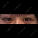 二重埋没 / 眼瞼下垂（非切開） SOL CLINIC BEFORE サムネイル用