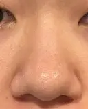 鼻尖形成（切開） / 軟骨移植 / 鼻柱下降・鼻唇角形成（猫手術） 東京美専クリニック BEFORE サムネイル用