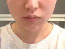 RF（高周波）たるみ治療 TUNE CLINIC【チューンクリニック】 BEFORE サムネイル用