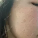 イオン導入 / ルメッカ ルラ美容クリニック 大宮院 / ルラスキンクリニック 大宮院 BEFORE サムネイル用