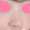 ヒアルロン酸注入（鼻） 神田美容外科形成外科医院 BEFORE サムネイル用