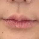 ヒアルロン酸注入（唇） / ボトックス（タレ目） / ボトックス（人中） アネシス美容クリニック BEFORE サムネイル用
