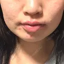 ボトックス（エラ・小顔） BiBiクリニック BEFORE サムネイル用