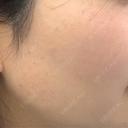 ピーリング（ハリ・ツヤ） / ルメッカ PureMe Skin Clinic（ピュアミースキンクリニック麻布） BEFORE サムネイル用