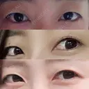 二重埋没 城本クリニック 姫路院 BEFORE サムネイル用