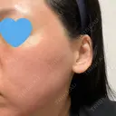 ヴェルヴェットスキン ゆう美容クリニック BEFORE サムネイル用