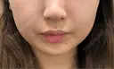 脂肪吸引注射（顔） EMMO FACE CLINIC 東京三田院 BEFORE サムネイル用