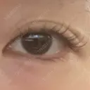 眼瞼下垂（非切開） SOL CLINIC BEFORE サムネイル用