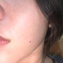 ピーリング（ハリ・ツヤ） / ルメッカ PureMe Skin Clinic（ピュアミースキンクリニック麻布） BEFORE サムネイル用