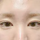 その他（目元） 東京形成美容外科 船橋院 BEFORE サムネイル用