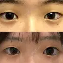 二重切開 水の森美容クリニック 横浜院 BEFORE サムネイル用