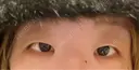 二重埋没 / 目頭切開 GRACIA clinic 【グラシアクリニック】 BEFORE サムネイル用