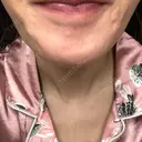 ボトックス（あご） / ボトックス（目尻） ルラ美容クリニック 新宿院 BEFORE サムネイル用