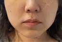 ボトックス（あご） / ボトックス（エラ・小顔） / 脂肪溶解注射（顔） / ボトックス（人中） Kinshicho Beauty Clinic （錦糸町ビューティークリニック） BEFORE サムネイル用
