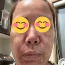 ピコレーザートーニング（美白・肝斑） / ピコフラクショナルレーザー（毛穴・ニキビ跡） / ピコスポット 東京シルククリニック 新宿院 BEFORE サムネイル用