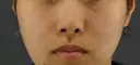 隆鼻術 / 鼻尖形成（切開） / 鼻中隔延長（切開） GRACIA clinic 【グラシアクリニック】 BEFORE サムネイル用
