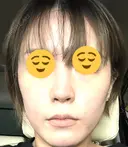 医療脱毛（顔） ZX-CLINIC 梅田院 BEFORE サムネイル用