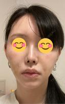ヒアルロン酸注入（鼻） プリモ麻布十番クリニック BEFORE サムネイル用