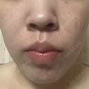 医療脱毛（全身） / ルメッカ Grias clinic （ジリアスクリニック） BEFORE サムネイル用