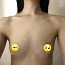 豊胸（シリコンバッグ） さくらビューティークリニック銀座 BEFORE サムネイル用