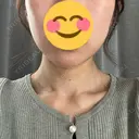 RF（高周波）たるみ治療 Clinic K Blossom BEFORE サムネイル用