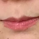 ヒアルロン酸注入（唇） フィラークリニック 大阪梅田院 BEFORE サムネイル用