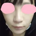 鼻尖形成（切開） / 小鼻縮小（切開） / 軟骨移植 / 骨切幅寄せ HANABI整形外科 BEFORE サムネイル用