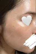 ほくろ・いぼ除去レーザー（肌） / シミ取りレーザー eクリニック 金沢本院 BEFORE サムネイル用