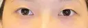 二重埋没 / 目尻切開 / タレ目形成・グラマラスライン（埋没） LOUIS CLINIC 二子玉川院【ルイクリニック】 BEFORE サムネイル用