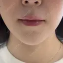 肌ヒアルロン酸注入（たるみ・シワ改善） KIMI CLINIC 形成・美容外科 BEFORE サムネイル用