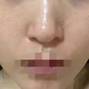 ポテンツァ ルラ美容クリニック 岡山院 BEFORE サムネイル用